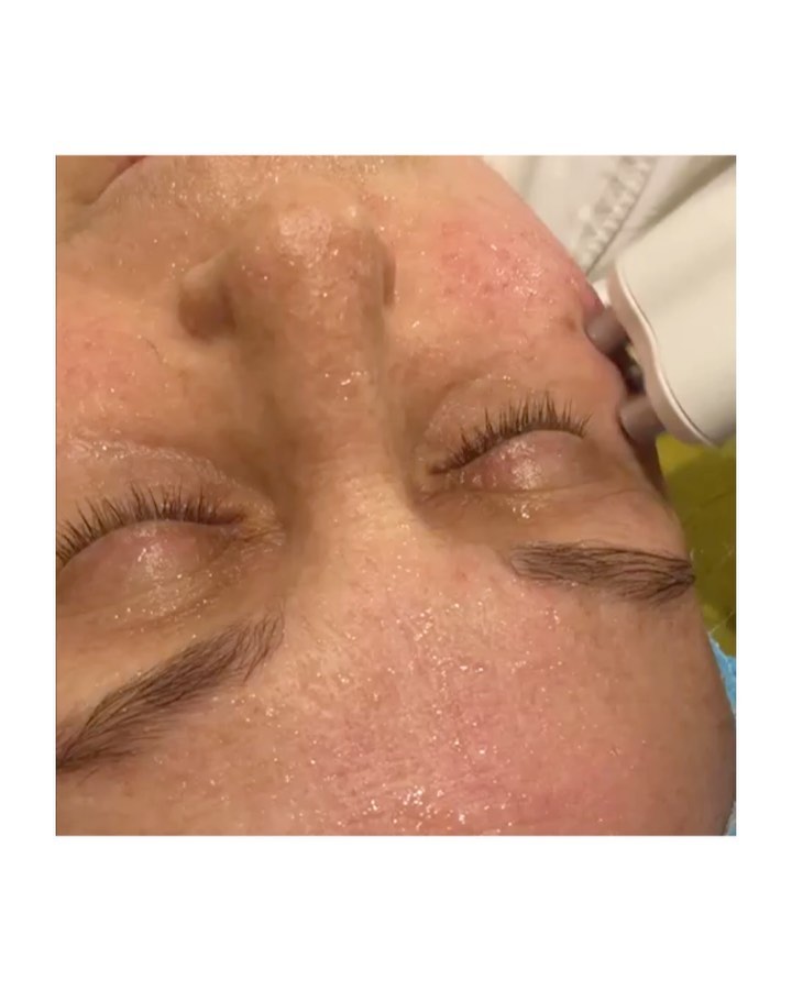 Una paciente con los ojos cerrados durante una sesión facial, con un cabezal blanco apoyado sobre la piel del rostro